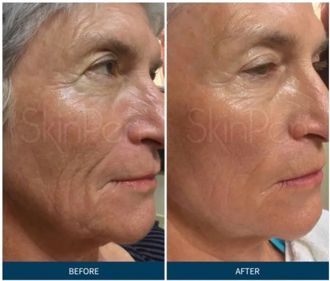 Laser Perfection Picture 5