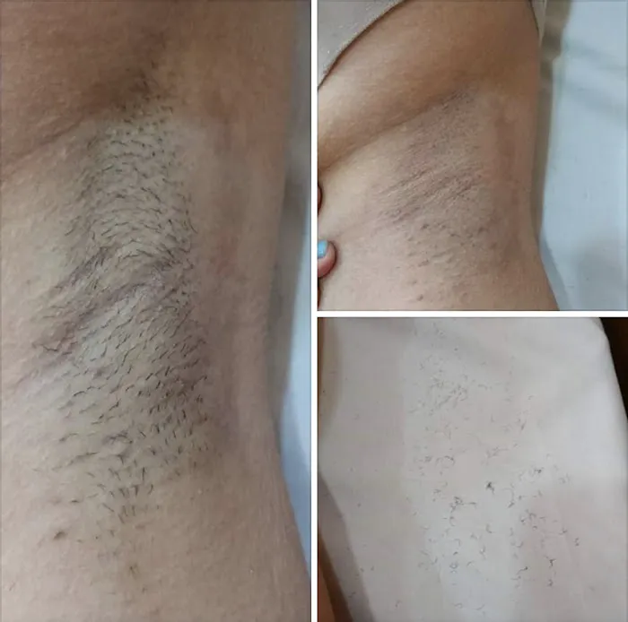 Silk Skin Laser Care Picture 2