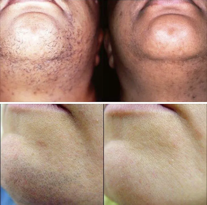 Silk Skin Laser Care Picture 1