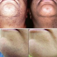 Silk Skin Laser Care ico