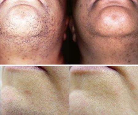 Silk Skin Laser Care