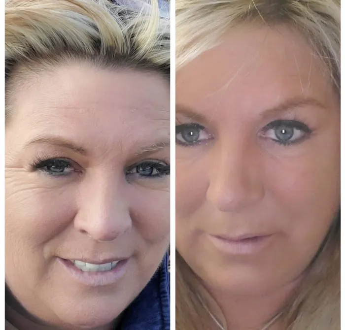 Silk Skin Laser Care Picture 6