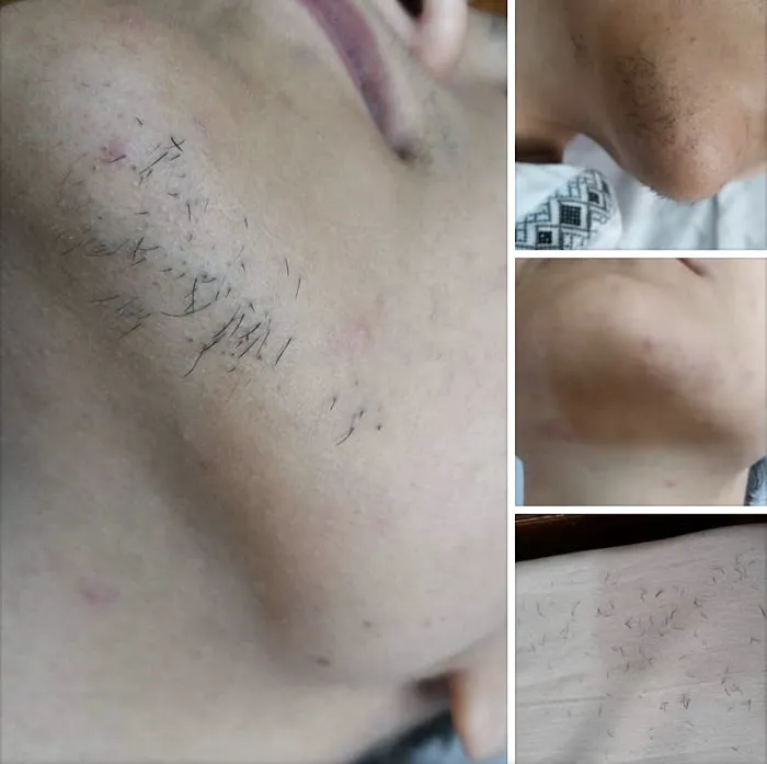 Silk Skin Laser Care Picture 9