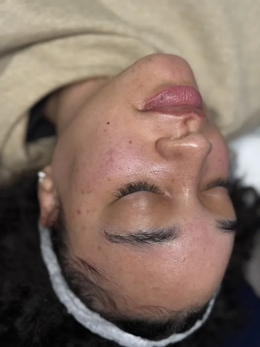 Mochi Aesthetics Clinic: Botox, PRF EzGel, Microneedling, Hydrafacial, CoolPeel Picture 1