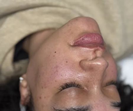 Mochi Aesthetics Clinic: Botox, PRF EzGel, Microneedling, Hydrafacial, CoolPeel