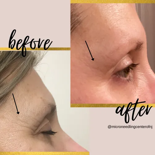 Microneedling Center of NJ LLC Picture 5