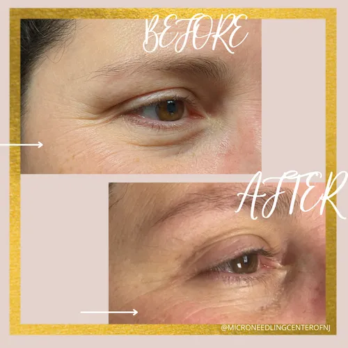 Microneedling Center of NJ LLC Picture 9