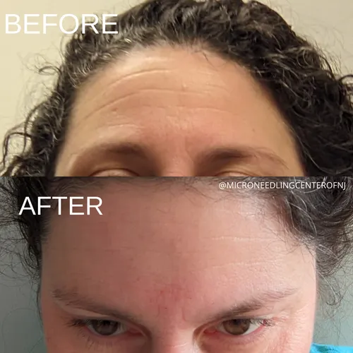 Microneedling Center of NJ LLC Picture 10