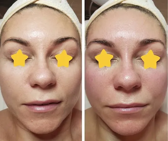 MY Microdermabrasion Picture 6