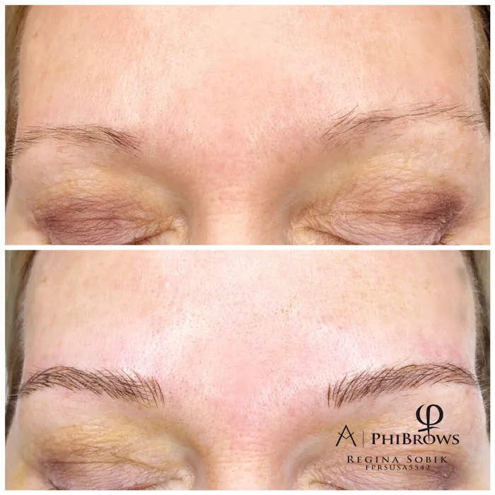 MY Microdermabrasion Picture 5