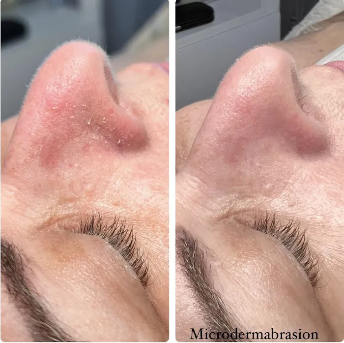 MY Microdermabrasion Picture 9