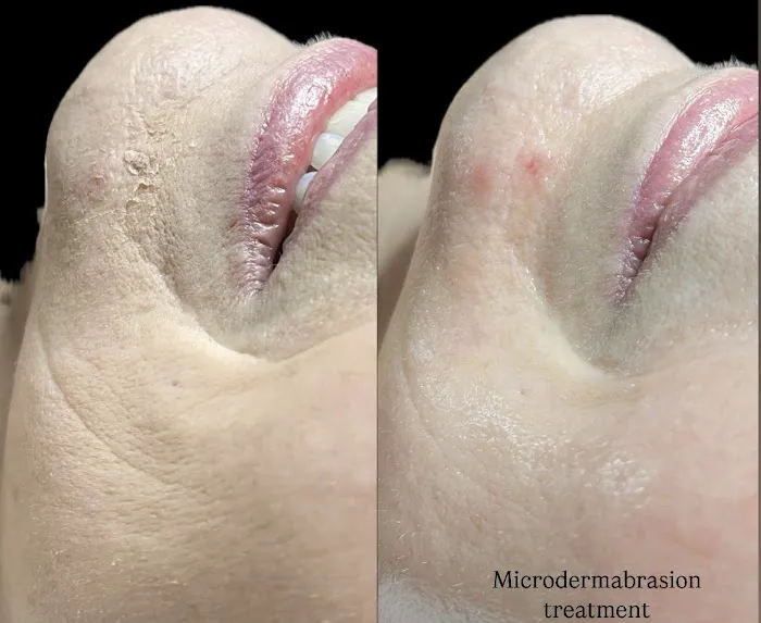 MY Microdermabrasion Picture 7