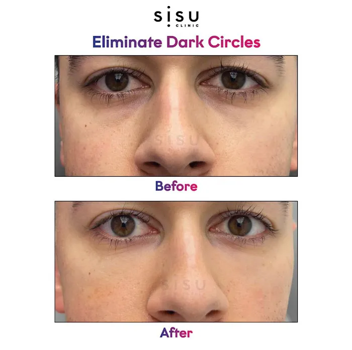 Sisu Clinic Soho | Doctor-led, Cosmetic Medicine & Treatments Picture 7