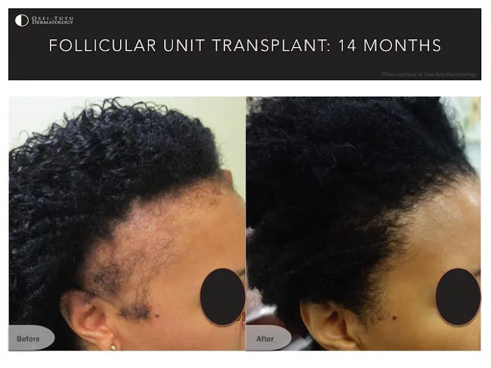 Osei-Tutu Dermatology & Hair Restoration Picture 9