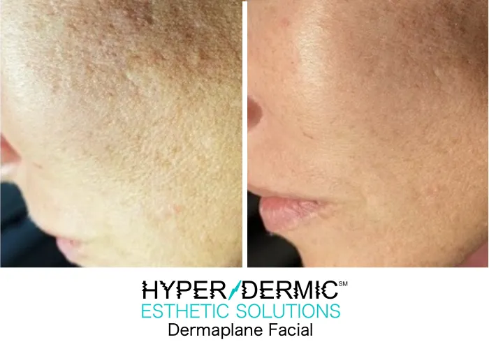 HyperDermic Esthetic Solutions Picture 5