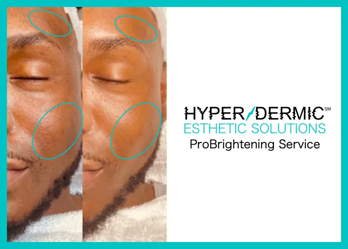 HyperDermic Esthetic Solutions Picture 3