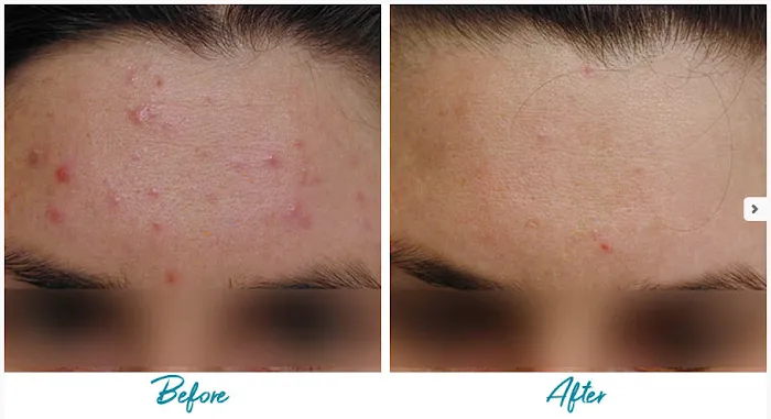 Alinea Medical Spa Acne Scar & Laser Skin Care NYC Picture 8