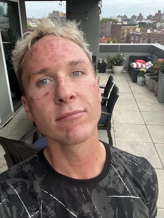 Alinea Medical Spa Acne Scar & Laser Skin Care NYC Picture 6