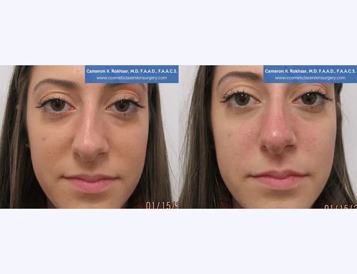 Non Surgical Nose Job Center Picture 6
