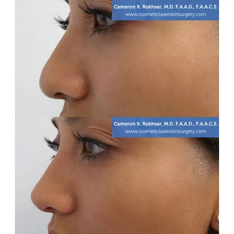 Non Surgical Nose Job Center Picture 7