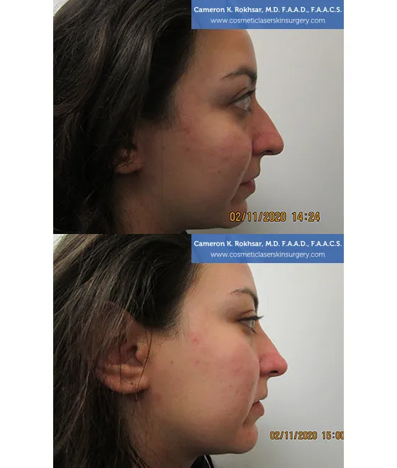 Non Surgical Nose Job Center Picture 9