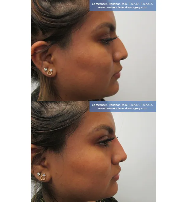 Non Surgical Nose Job Center Picture 10