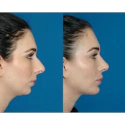 Restylane NYC Picture 1