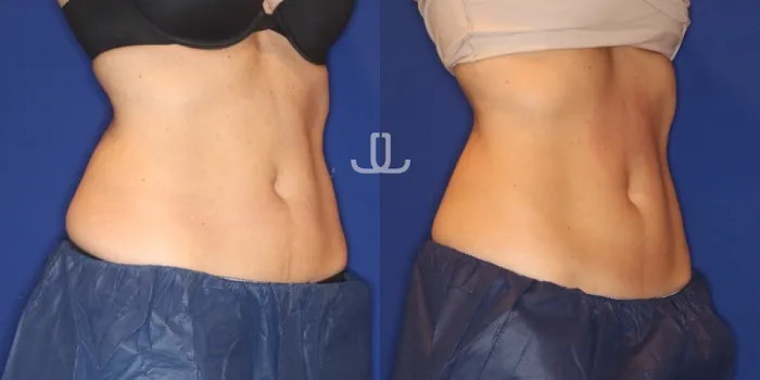 JL Body Sculpting: Emsculpt NEO, Laser Resurfacing NYC, Ultherapy for Body, PRP for Hair Loss Picture 4