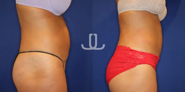 JL Body Sculpting: Emsculpt NEO, Laser Resurfacing NYC, Ultherapy for Body, PRP for Hair Loss Picture 6