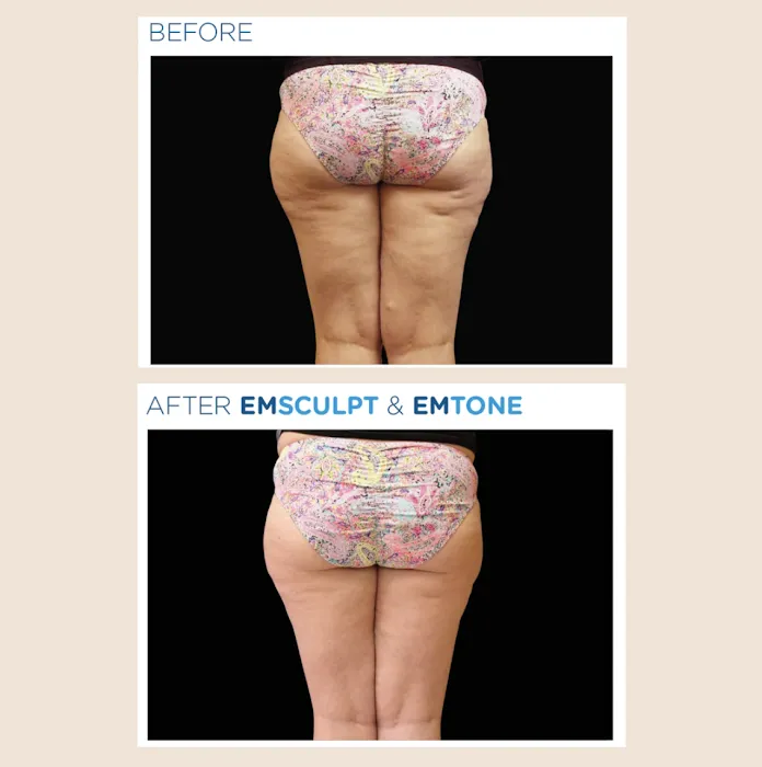 JL Body Sculpting: Emsculpt NEO, Laser Resurfacing NYC, Ultherapy for Body, PRP for Hair Loss Picture 5