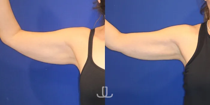 JL Body Sculpting: Emsculpt NEO, Laser Resurfacing NYC, Ultherapy for Body, PRP for Hair Loss Picture 7