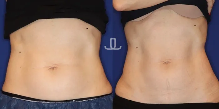 JL Body Sculpting: Emsculpt NEO, Laser Resurfacing NYC, Ultherapy for Body, PRP for Hair Loss Picture 9