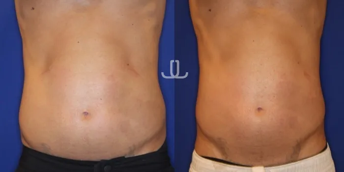 JL Body Sculpting: Emsculpt NEO, Laser Resurfacing NYC, Ultherapy for Body, PRP for Hair Loss Picture 10