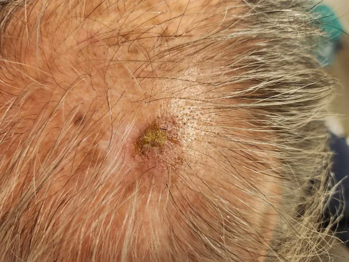 Jaffe, O'Neill, Lindgren, Affiliate of Anne Arundel Dermatology Picture 3