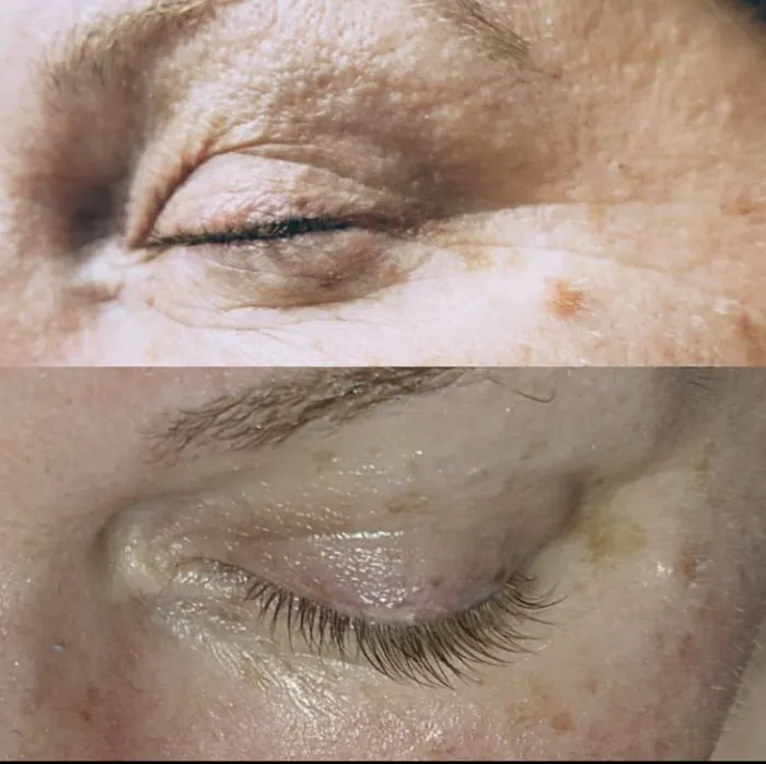 Bare Facts Skin Aesthetics-Facials-Peels-Collagen Induced Therapy-Needling- Electrolysis-Ear Lobe & Helix Piercing. Picture 2