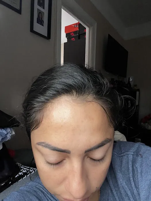 Alta Aesthetics - Morpheus8 - Laser Hair Removal Picture 6