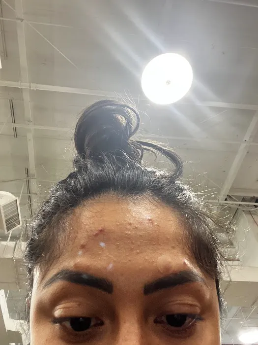 Alta Aesthetics - Morpheus8 - Laser Hair Removal Picture 5