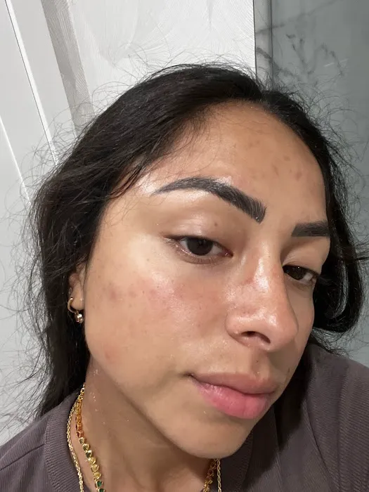 Alta Aesthetics - Morpheus8 - Laser Hair Removal Picture 7