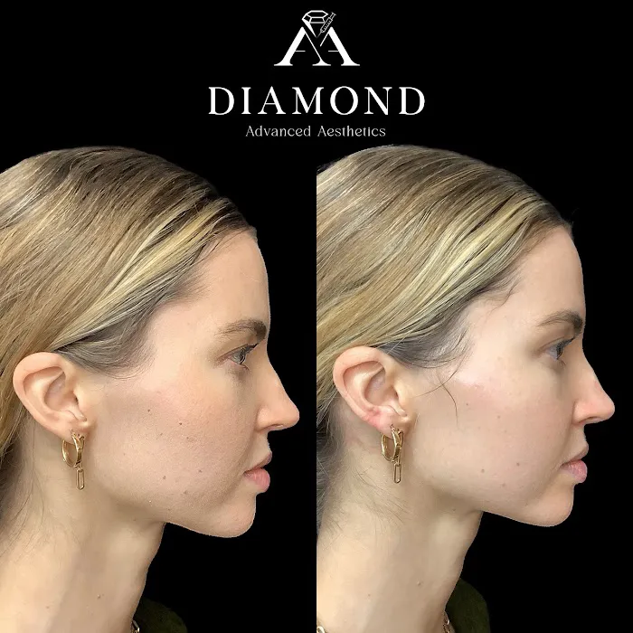 Hydrafacial Treatment Midtown Picture 7