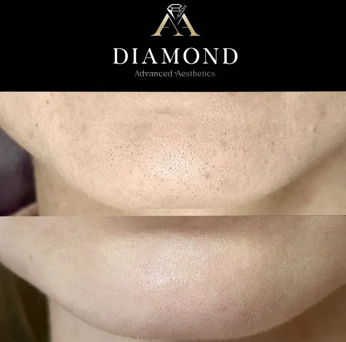 Hydrafacial Treatment Midtown Picture 10