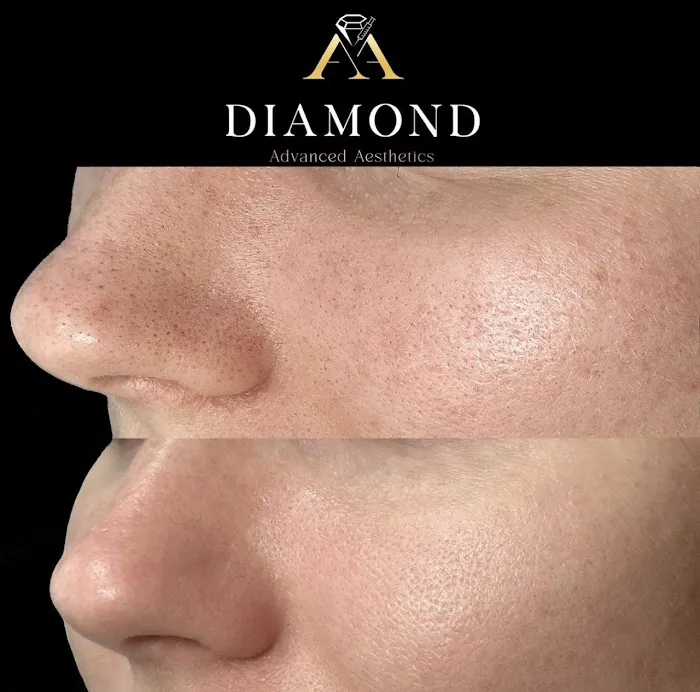 Hydrafacial Treatment Midtown Picture 9