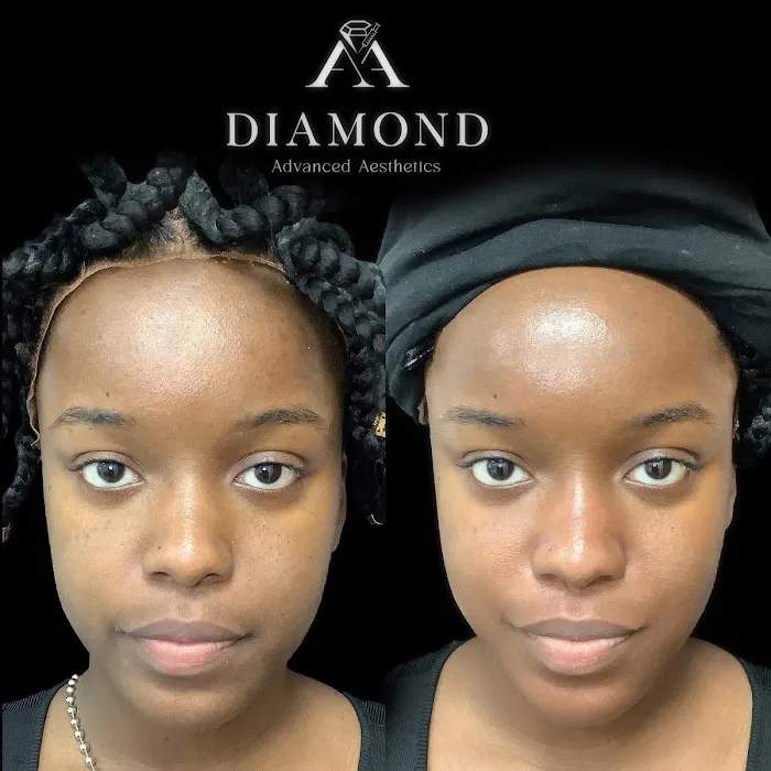 Hydrafacial Treatment Midtown Picture 8