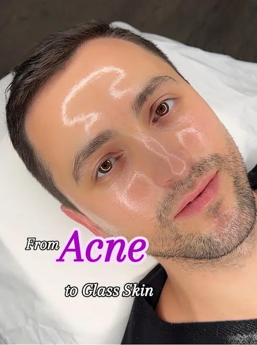 First Acne Clinic with AviClear Picture 1