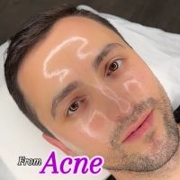 First Acne Clinic with AviClear ico