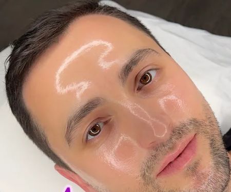 First Acne Clinic with AviClear