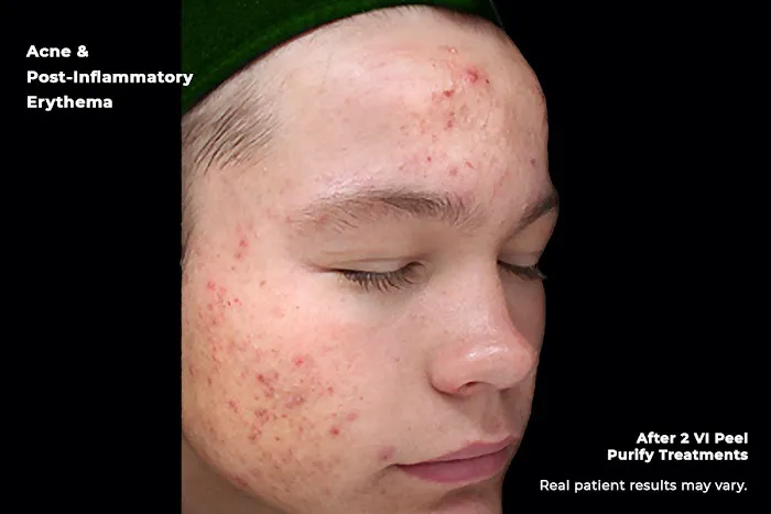 First Acne Clinic with AviClear Picture 10