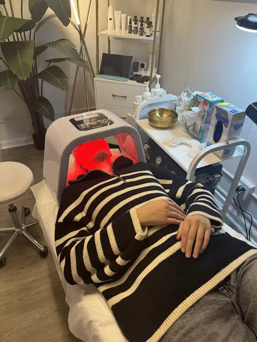 FaceLift Clinic & SPA : Fotona 4D Hyperpigmentation Melasma Picture 2