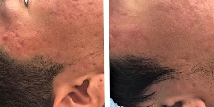 Acne Scar Treatment Center Picture 6