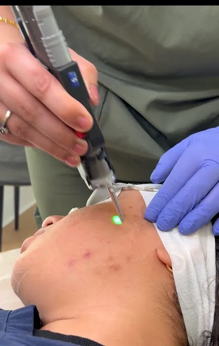 Nudeskin Laser Hair Removal Picture 3