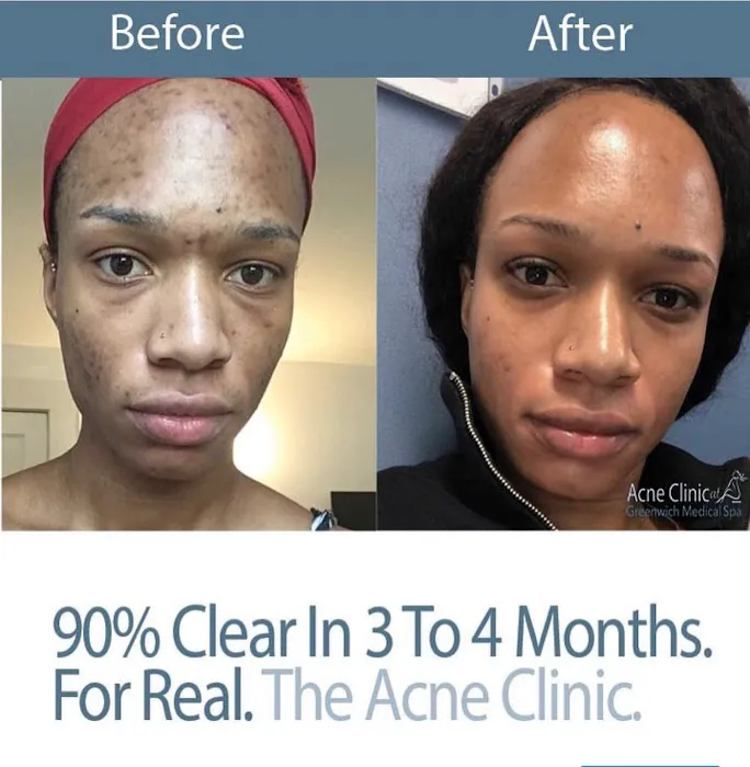 The Acne Clinic at Greenwich Medical Spa Westport Picture 8